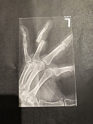 finger x ray2